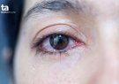 Bệnh đau mắt đỏ và cách phòng chống