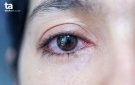 Bệnh đau mắt đỏ và cách phòng chống